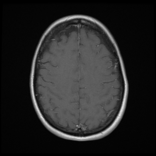 File:Neurofibromatosis type 2 - bilateral acoustic neuromata (Radiopaedia 40060-42566 Axial T1 C+ 16).png