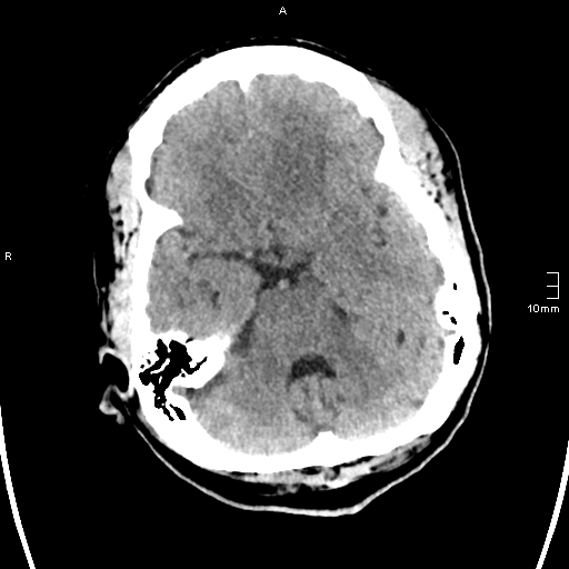File:Neurotoxoplasmosis - concentric target sign (Radiopaedia 70644-80783 Axial non-contrast 10).jpg