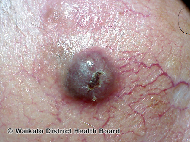 File:Nodular melanoma (DermNet NZ melanoma-abcds-26).jpg