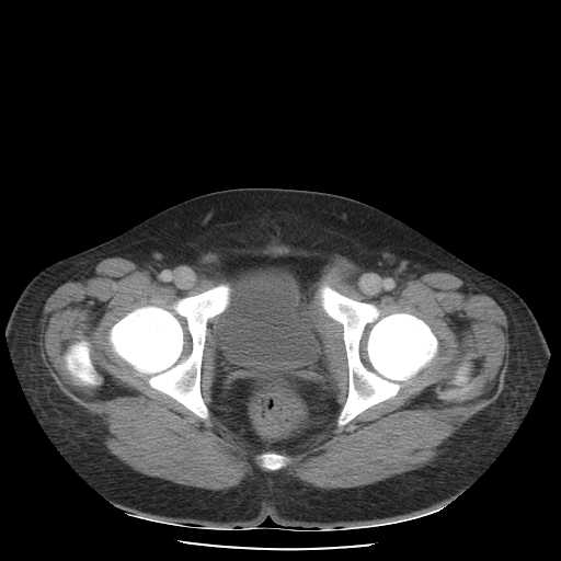 File:Non-Hodgkin lymphoma involving pelvis (Radiopaedia 21281-21197 A 59).jpg