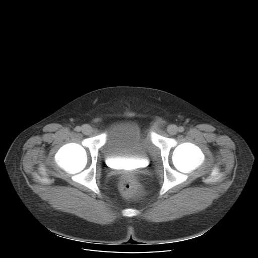 File:Non-Hodgkin lymphoma involving pelvis (Radiopaedia 21281-21197 B 59).jpg