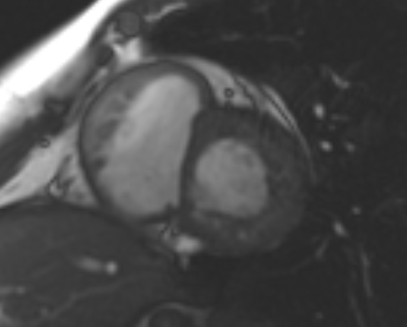 File:Non-compaction of the left ventricle (Radiopaedia 69436-79314 Short axis cine 145).jpg