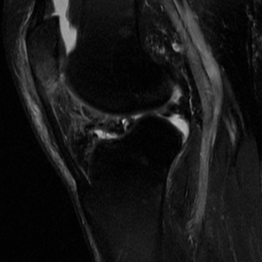 File:Non-displaced patella fracture (Radiopaedia 15932-15582 Sagittal T2 fat sat 11).jpg