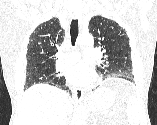 Non-specific interstitial pneumonia (NSIP) (Radiopaedia 68599-78228 Coronal lung window 50).jpg