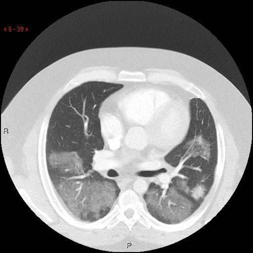 File:Non-specific interstitial pneumonitis (Radiopaedia 27044-27222 Axial lung window 30).jpg