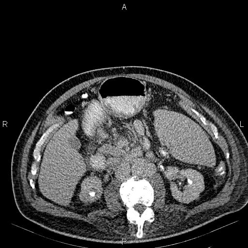 Non Hodgkin lymphoma in a patient with ankylosing spondylitis (Radiopaedia 84323-99621 Axial C+ delayed 33).jpg