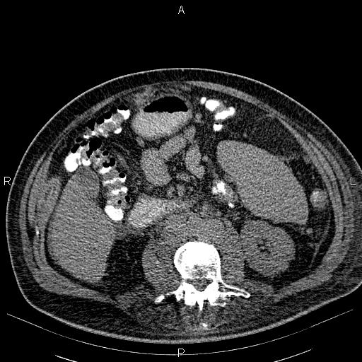 File:Non Hodgkin lymphoma in a patient with ankylosing spondylitis (Radiopaedia 84323-99621 Axial non-contrast 39).jpg