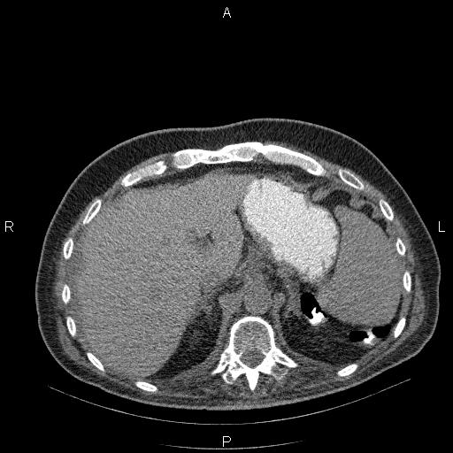 File:Non Hodgkin lymphoma in a patient with ankylosing spondylitis (Radiopaedia 84323-99624 Axial non-contrast 31).jpg