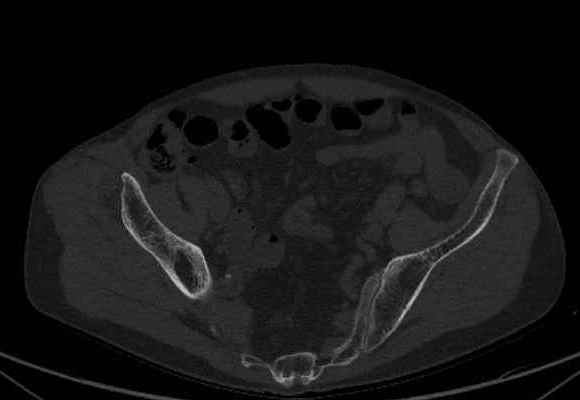 File:Nondisplaced incomplete intertrochanteric fracture (Radiopaedia 73736-84539 Axial bone window 2).jpg