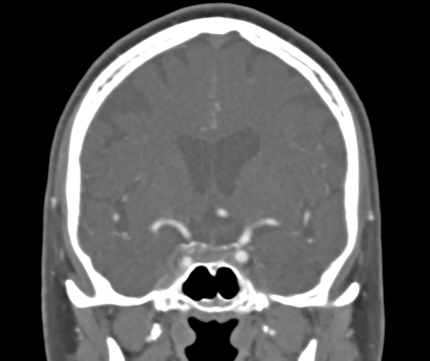 File:Normal CTA head (Radiopaedia 40801-43464 B 44).png