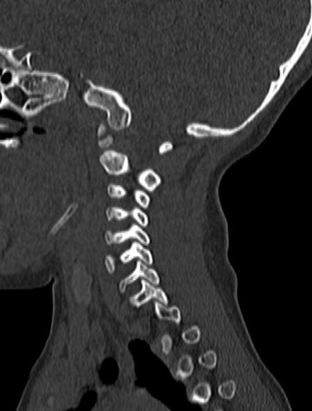 File:Normal CT cervical spine - pediatric (Radiopaedia 52549-58462 Sagittal bone window 152).jpg