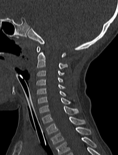 Normal CT cervical spine - pediatric (Radiopaedia 52549-58462 Sagittal bone window 93).jpg