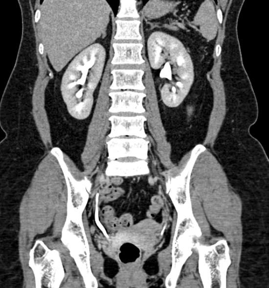 Normal CT intravenous urogram (Radiopaedia 39444-41759 A 303).jpg