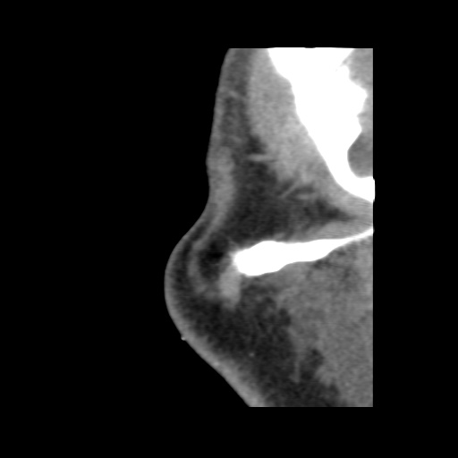 Normal CT paranasal sinuses (Radiopaedia 42286-45390 F 16).jpg