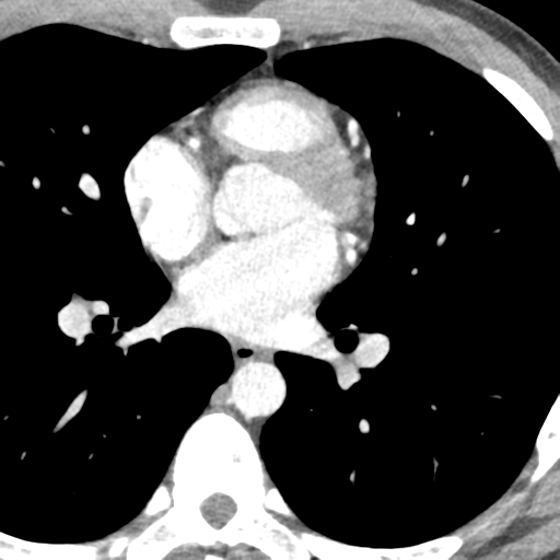 File:Normal CT pulmonary veins (pre RF ablation) (Radiopaedia 41748-44702 A 158).png