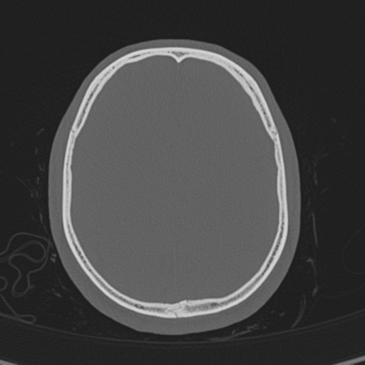 Normal CT skull (Radiopaedia 40798-43459 A 115).png