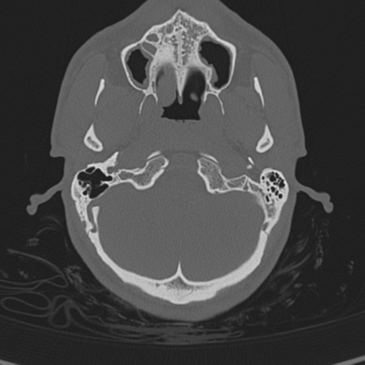 Normal CT skull (Radiopaedia 40798-43459 A 21).png
