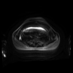 Normal MRI abdomen in pregnancy (Radiopaedia 88001-104541 Axial DWI 99).jpg