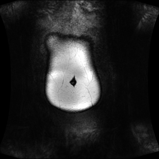 Normal MRI abdomen in pregnancy (Radiopaedia 88001-104541 N 15).jpg
