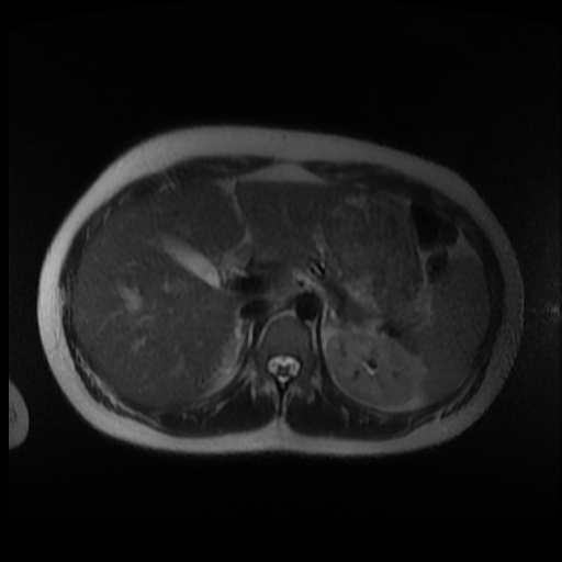 Normal MRI abdomen in pregnancy (Radiopaedia 88003-104546 Axial T2 3).jpg