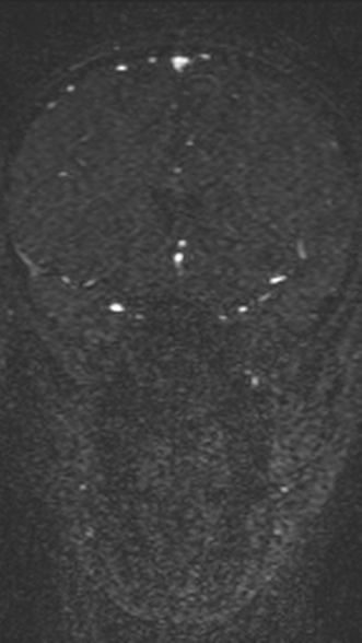Normal MRI brain with MRV- teenager (Radiopaedia 49425-54553 Coronal MRV 99).jpg