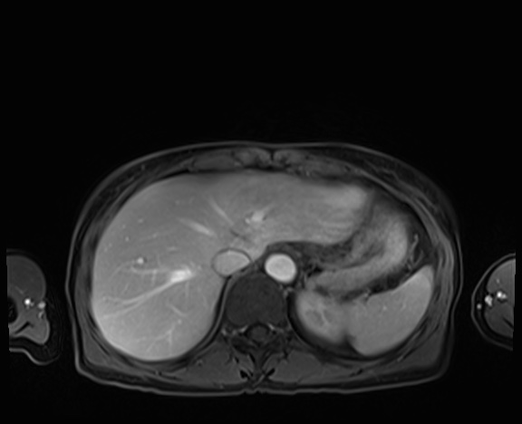 Normal adrenal glands MRI (Radiopaedia 82017-96004 K 17).jpg