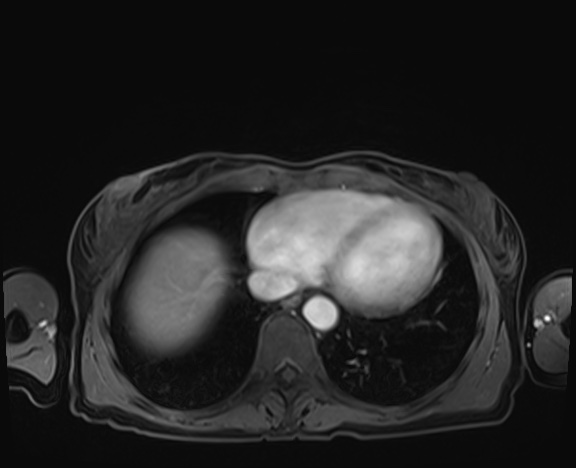 Normal adrenal glands MRI (Radiopaedia 82017-96004 K 4).jpg
