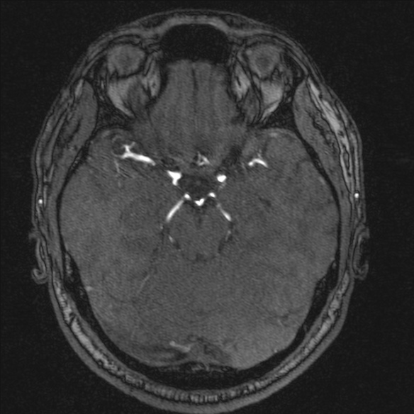 Normal brain MRI including MRA (Radiopaedia 48748-53763 Axial MRA 77).jpg