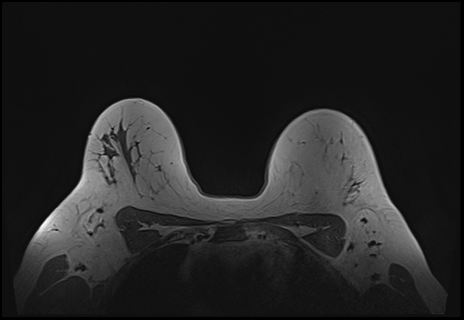 File:Normal breast MRI - dense breasts (Radiopaedia 80454-93850 Axial T1 168).jpg