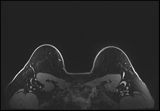 Normal breast MRI - dense breasts (Radiopaedia 80454-93850 C 201).jpg