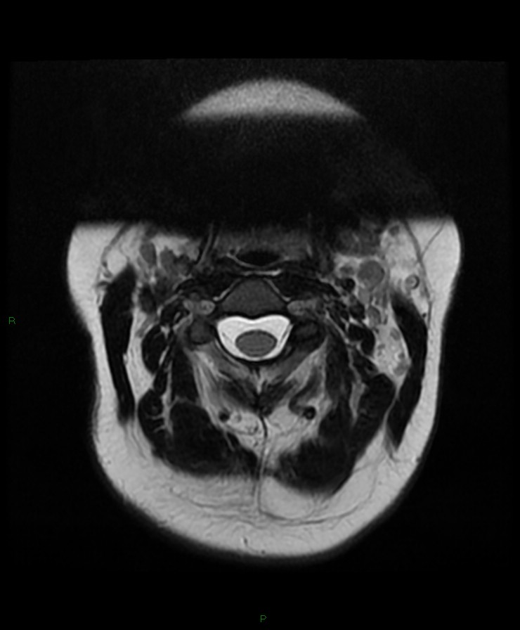 Normal cervical spine MRI (Radiopaedia 80146-93454 Axial T2 16).jpg