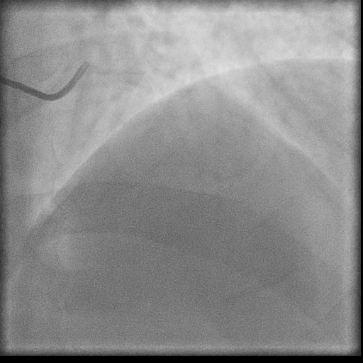 Normal coronary angiogram (DSA) (Radiopaedia 63081-71571 E 1).jpg