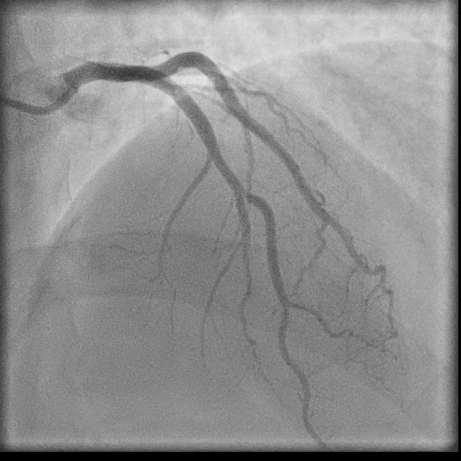 Normal coronary angiogram (DSA) (Radiopaedia 63081-71571 E 46).jpg
