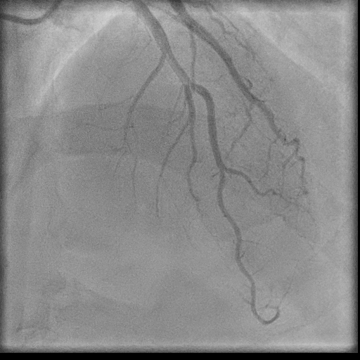 Normal coronary angiogram (DSA) (Radiopaedia 63081-71571 E 58).jpg