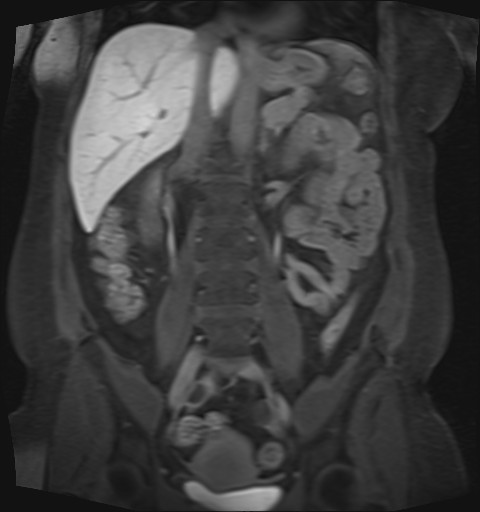 File:Normal hepatobiliary phase liver MRI (Radiopaedia 58968-66230 B 23).jpg