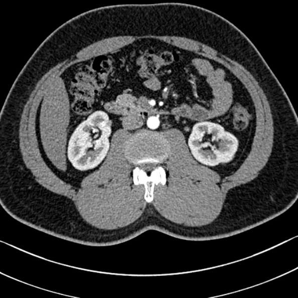 Normal kidneys on 4-phase CT study (Radiopaedia 25889-26038 B 50).jpg