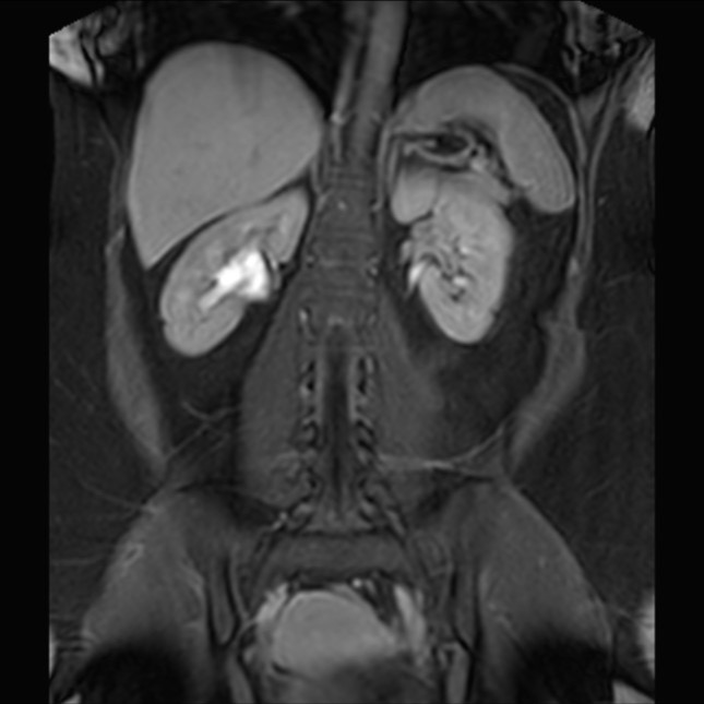 Normal liver MRI with Gadolinium (Radiopaedia 58913-66163 P 57).jpg
