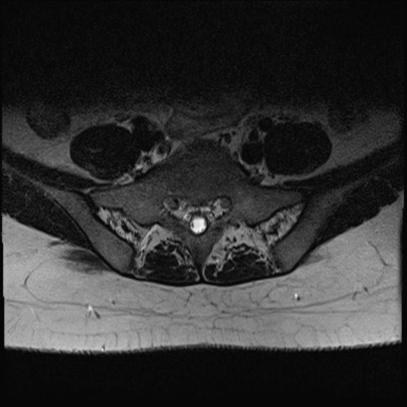 File:Normal lumbar spine MRI- 3 T (Radiopaedia 53280-59250 Axial T2 31).jpg