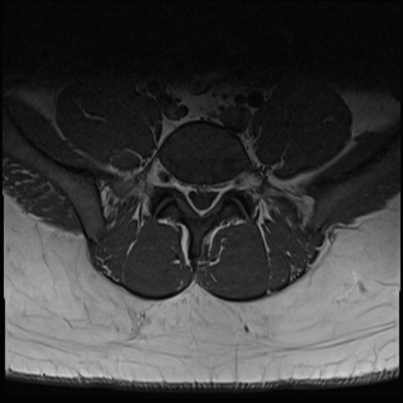 File:Normal lumbar spine MRI (Radiopaedia 47857-52609 Axial T1 25).jpg