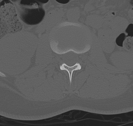File:Normal lumbosacral CT (Radiopaedia 37923-39867 Axial bone window 44).png
