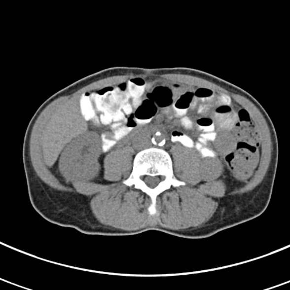 File:Normal multiphase CT liver (Radiopaedia 38026-39996 Axial non-contrast 46).jpg
