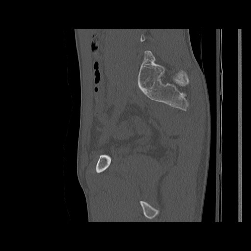 Normal pelvis (Radiopaedia 51473-57238 Sagittal bone window 96).jpg