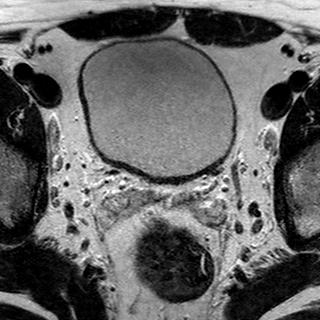 File:Normal prostate (MRI) (Radiopaedia 29986-30535 Axial T2 24).jpg