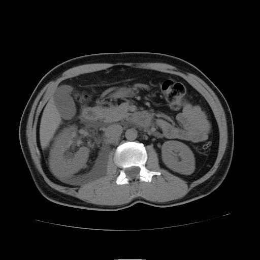 File:Obstructed kidney with perinephric urinoma (Radiopaedia 26889-27066 Axial non-contrast 19).jpg