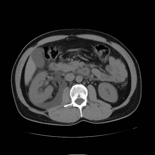 File:Obstructed kidney with perinephric urinoma (Radiopaedia 26889-27066 Axial non-contrast 22).jpg