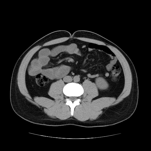 File:Obstructing ureteric calculus (Radiopaedia 18615-18514 Axial non-contrast 31).jpg