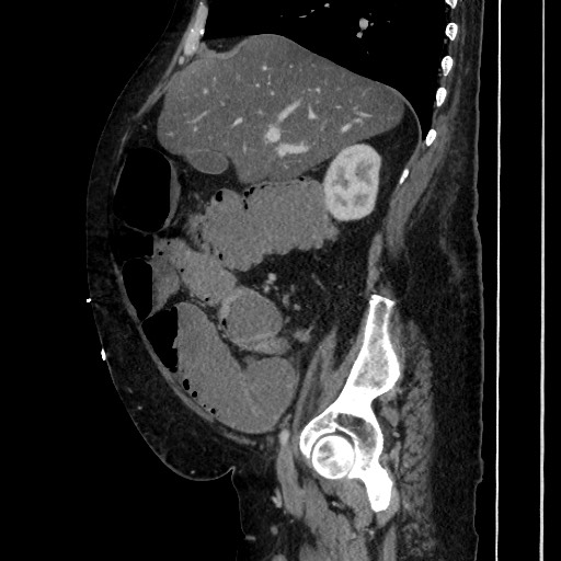 Obstructive colonic diverticular stricture (Radiopaedia 81085-94675 C 86).jpg
