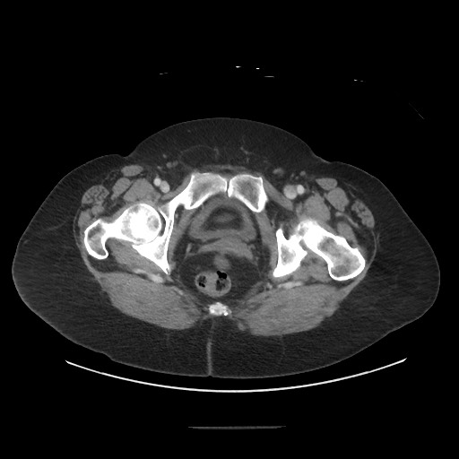 Obstructive distal colonic adenocarcinoma causing cecal perforation (Radiopaedia 86830-102989 A 186).jpg