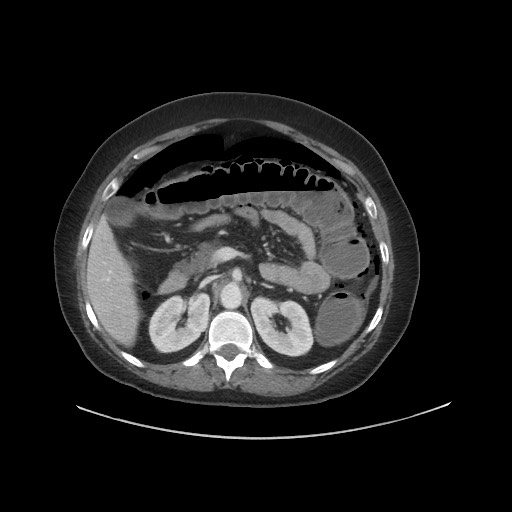 Obstructive distal colonic adenocarcinoma causing cecal perforation (Radiopaedia 86830-102989 A 71).jpg