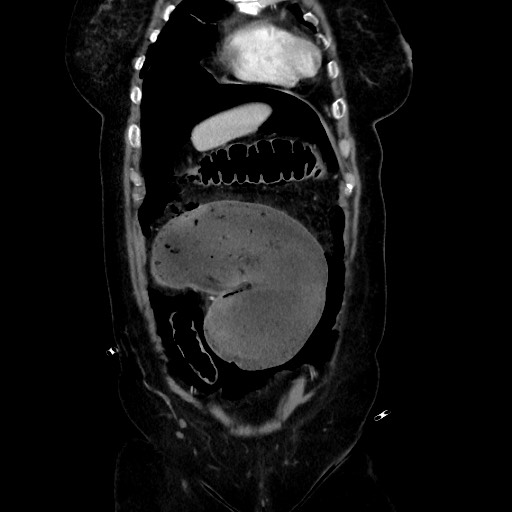 Obstructive distal colonic adenocarcinoma causing cecal perforation (Radiopaedia 86830-102989 C 59).jpg